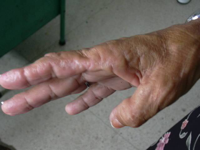 Acro-querato-elastoidosis en mano - <div style=